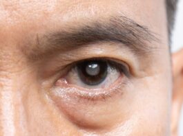 Cataract Surgery in Buffalo Ophthalmologist Answers YourQuestions